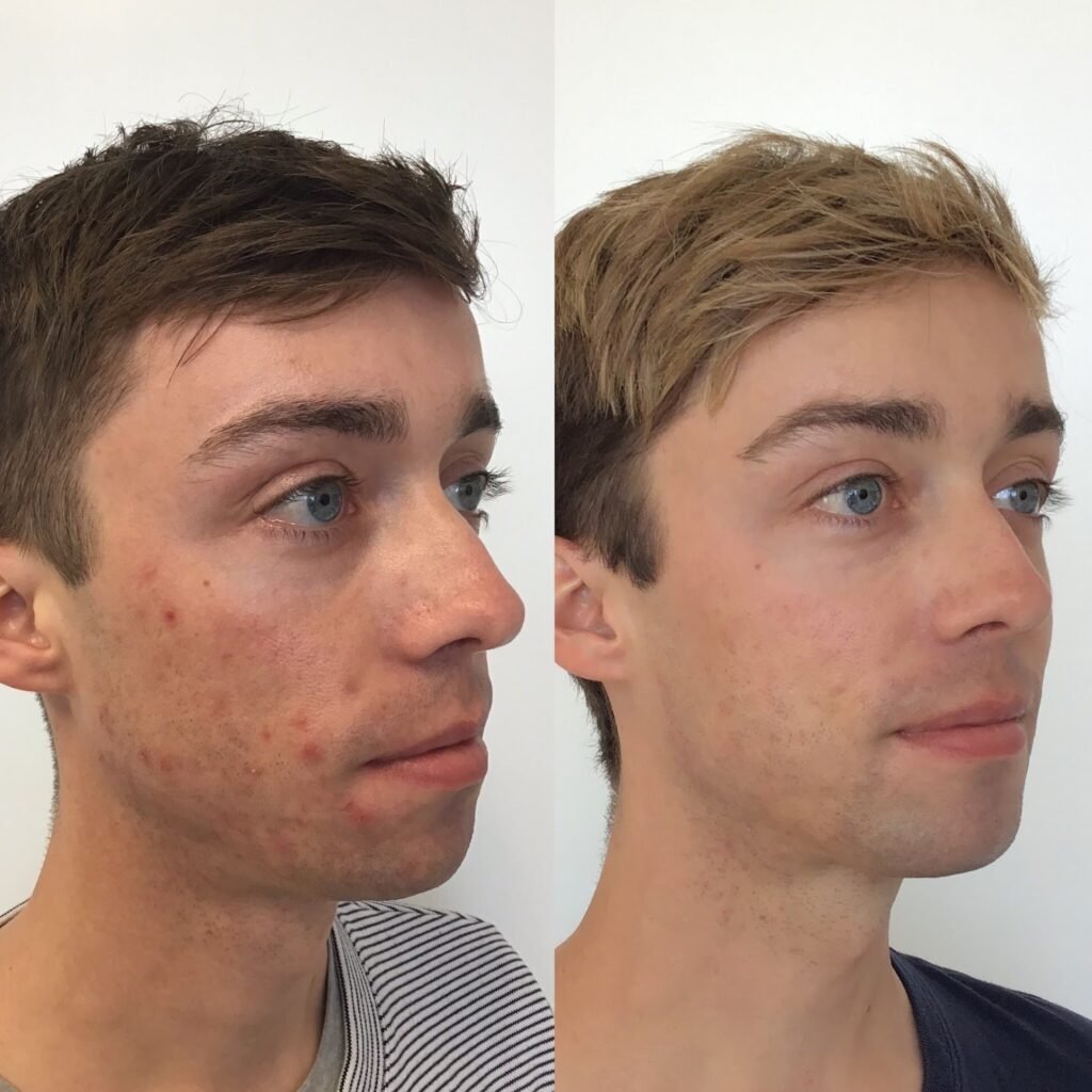How High-Strength Tretinoin 0.1% Transforms Acne-Prone Skin Over Time 4 image 1
