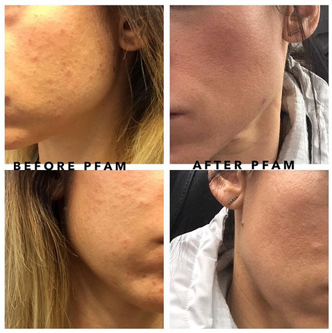 How High-Strength Tretinoin 0.1% Transforms Acne-Prone Skin Over Time 5 image 1