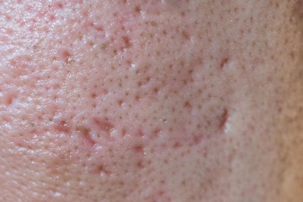 How High-Strength Tretinoin 0.1% Transforms Acne-Prone Skin Over Time 3 image 2