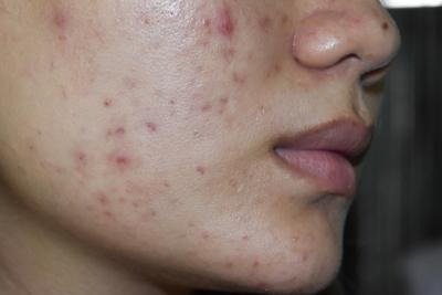 How High-Strength Tretinoin 0.1% Transforms Acne-Prone Skin Over Time 2 image
